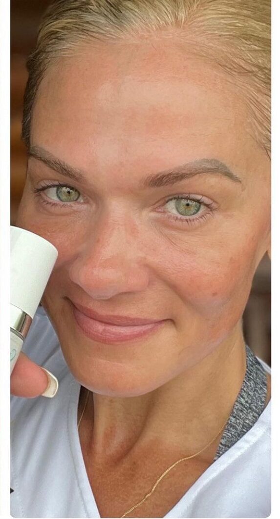 After Image: Laser Tx and Filler - front