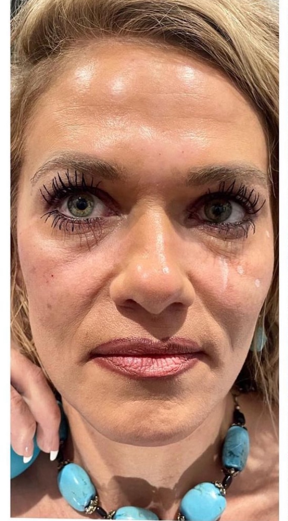 Before Image: Skin Rejuvenation - front