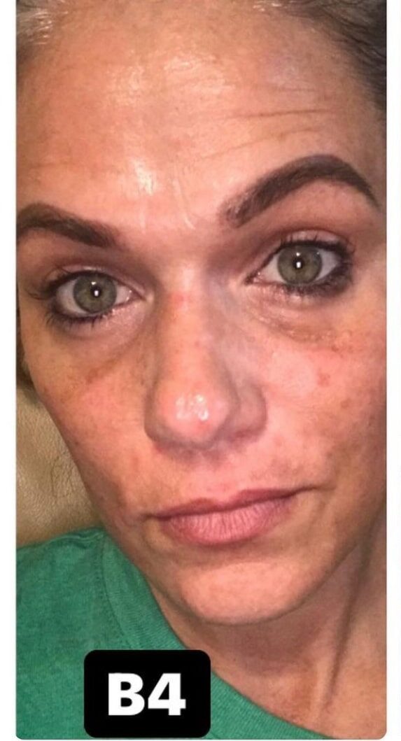 Before Image: Laser Tx and Filler - front