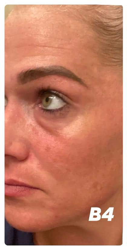 Before Image: Laser Tx and Filler - front