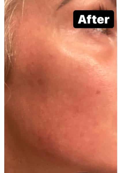 After Image: Pigment & Redness and PicoSure - right-front-oblique