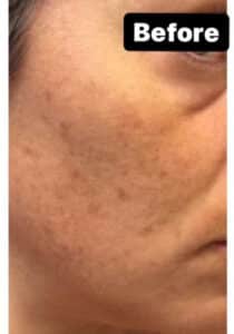 Before Image: Pigment & Redness and PicoSure