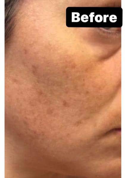 Before Image: Pigment & Redness and PicoSure - right-front-oblique