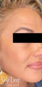 After Image: PicoSure