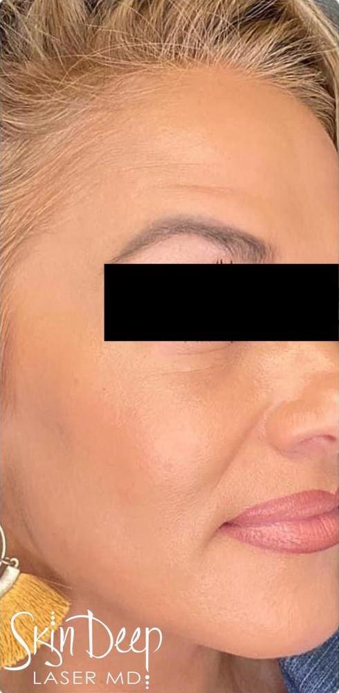 After Image: PicoSure - front