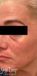 Before Image: PicoSure