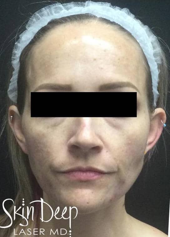 After Image: Peel - front