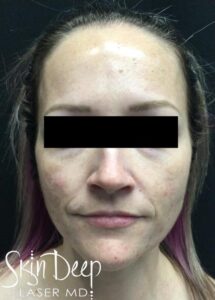 Before Image: Peel