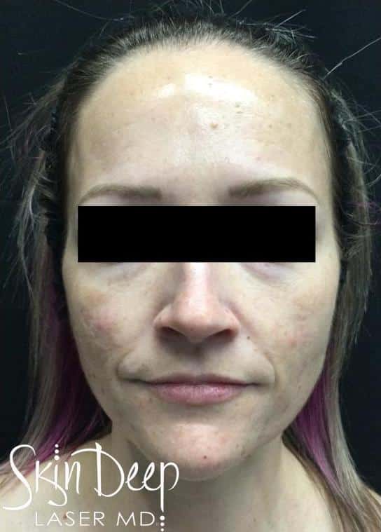 Before Image: Peel - front