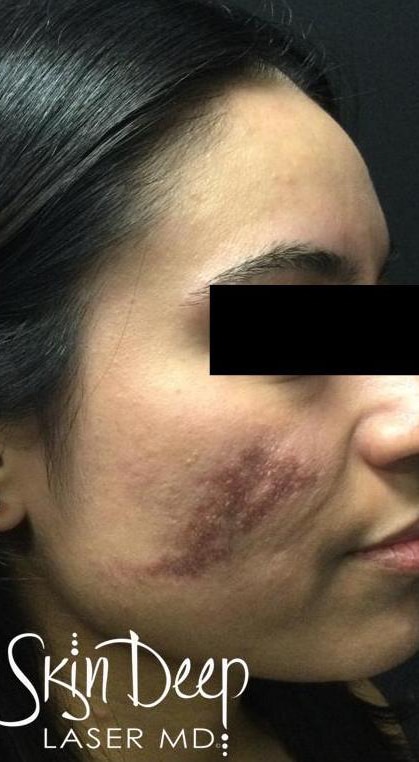 Before Image: Pico Scars - right-front-oblique