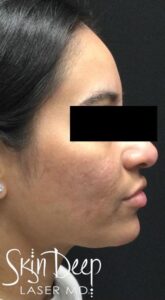 After Image: Pico Scars