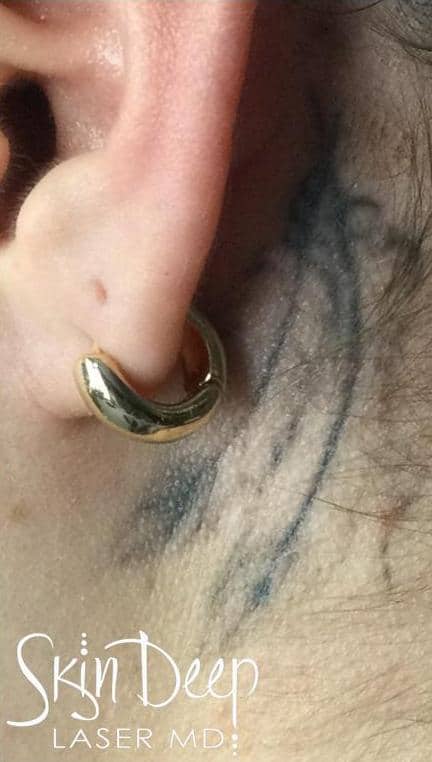After Image: Laser Tattoo Removal - left-side