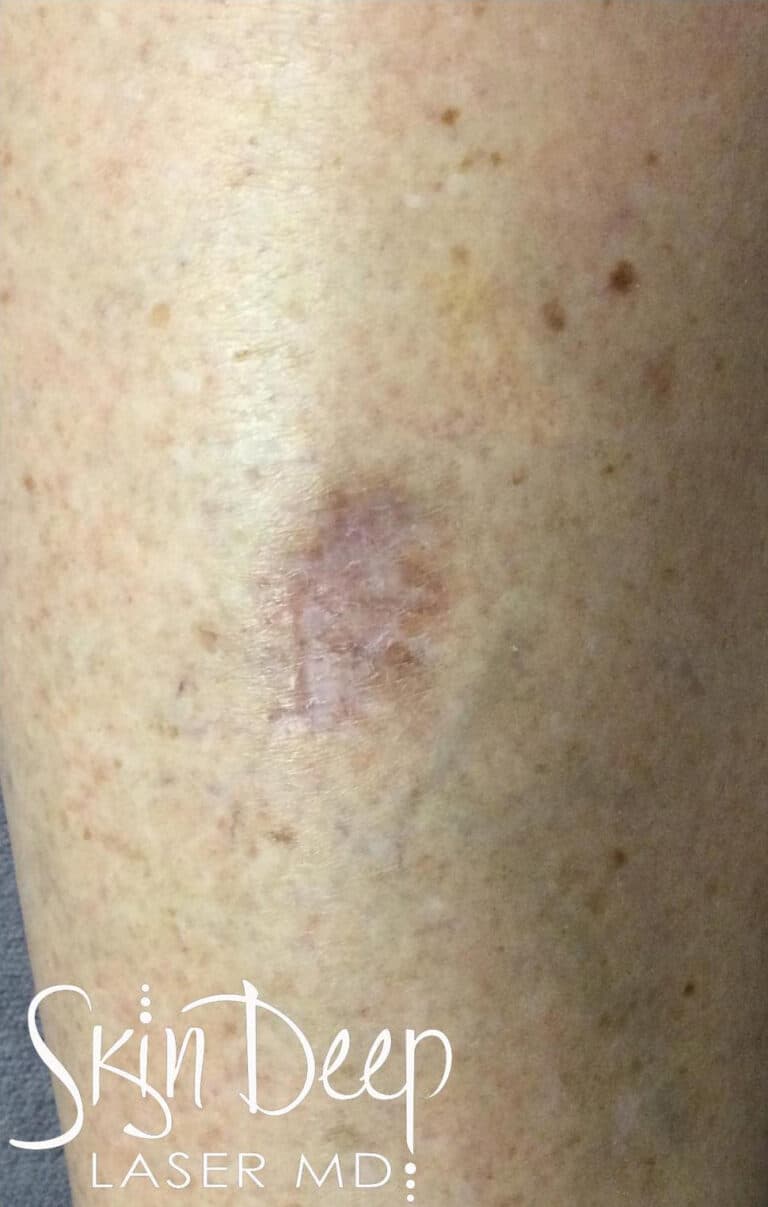 Before Image: IPL Red Scar - front
