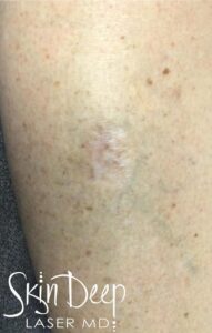 After Image: IPL Red Scar