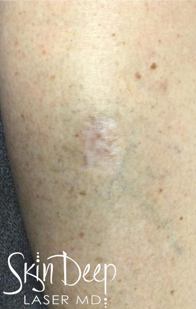 After Image: IPL Red Scar - front