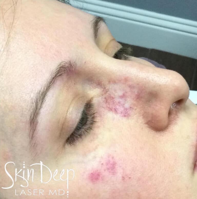 Before Image: IPL Port Wine - right-front-oblique