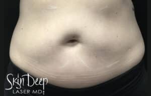 Before Image: SculpSure Body