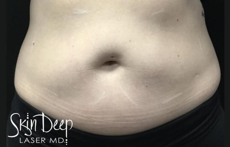 Before Image: SculpSure Body - front