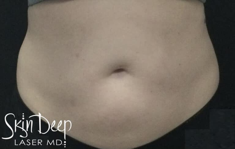 After Image: SculpSure Body - front