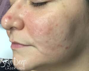 Before Image: IPL Difusse Red
