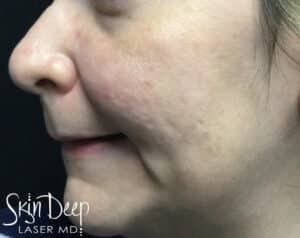 After Image: IPL Difusse Red