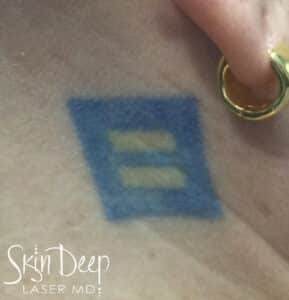 Before Image: Laser Tattoo Removal