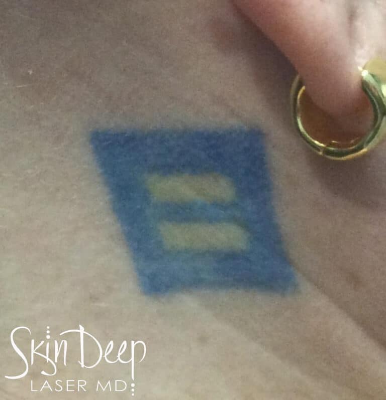 Before Image: Laser Tattoo Removal - right-side