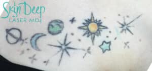 Before Image: Laser Tattoo Removal