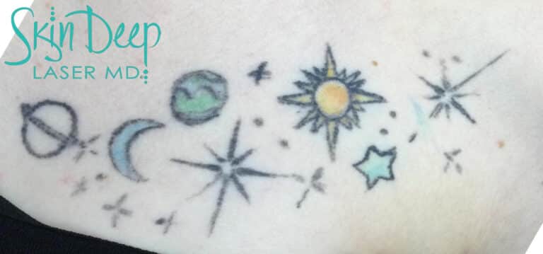Before Image: Laser Tattoo Removal - front