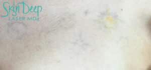 After Image: Laser Tattoo Removal