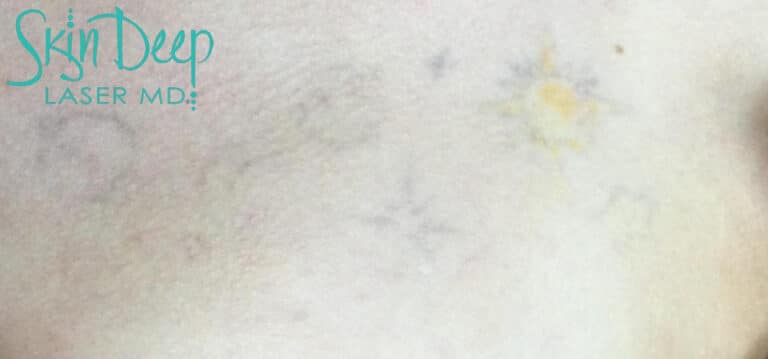 After Image: Laser Tattoo Removal - front