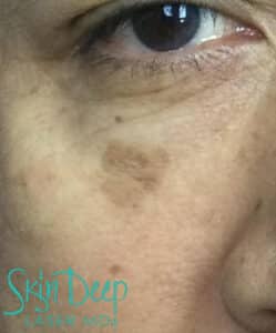 Before Image: PicoSure and Pigment & Redness