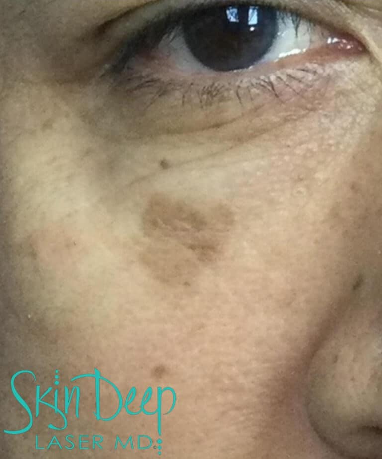 Before Image: PicoSure and Pigment & Redness - right-front-oblique