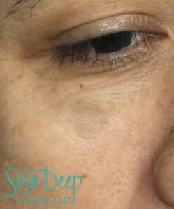 After Image: PicoSure and Pigment & Redness