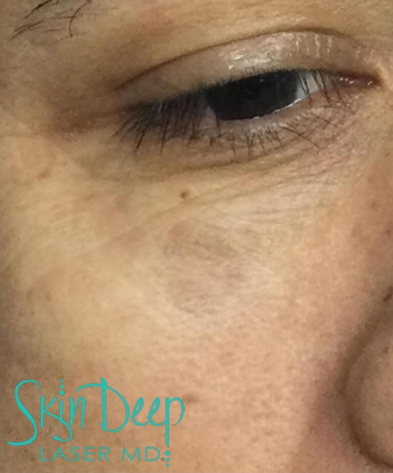 After Image: PicoSure and Pigment & Redness - right-front-oblique