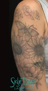 Before Image: Laser Tattoo Removal