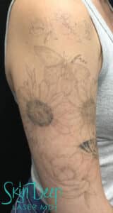 After Image: Laser Tattoo Removal