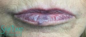 Before Image: IPL and Pigment & Redness