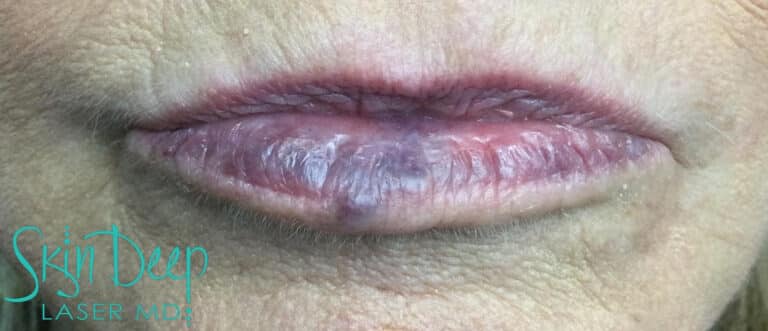 Before Image: IPL and Pigment & Redness - front