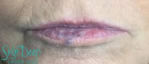After Image: IPL and Pigment & Redness