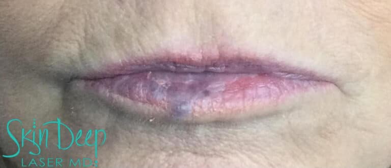 After Image: IPL and Pigment & Redness - front