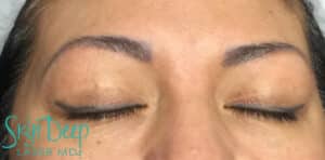 Before Image: Laser Tattoo Removal