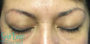 After Image: Laser Tattoo Removal