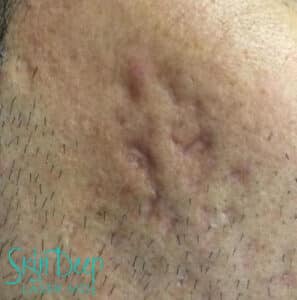 Before Image: Scars & Stretch Marks