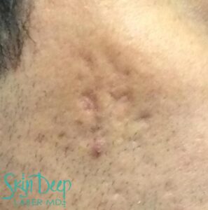 After Image: Scars & Stretch Marks