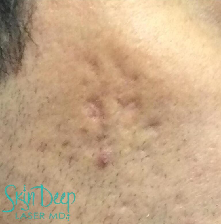 After Image: Scars & Stretch Marks - right-front-oblique