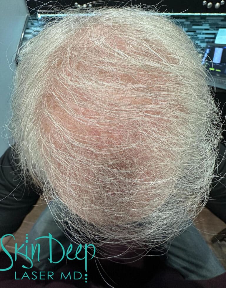 After Image: Hair Restoration - front