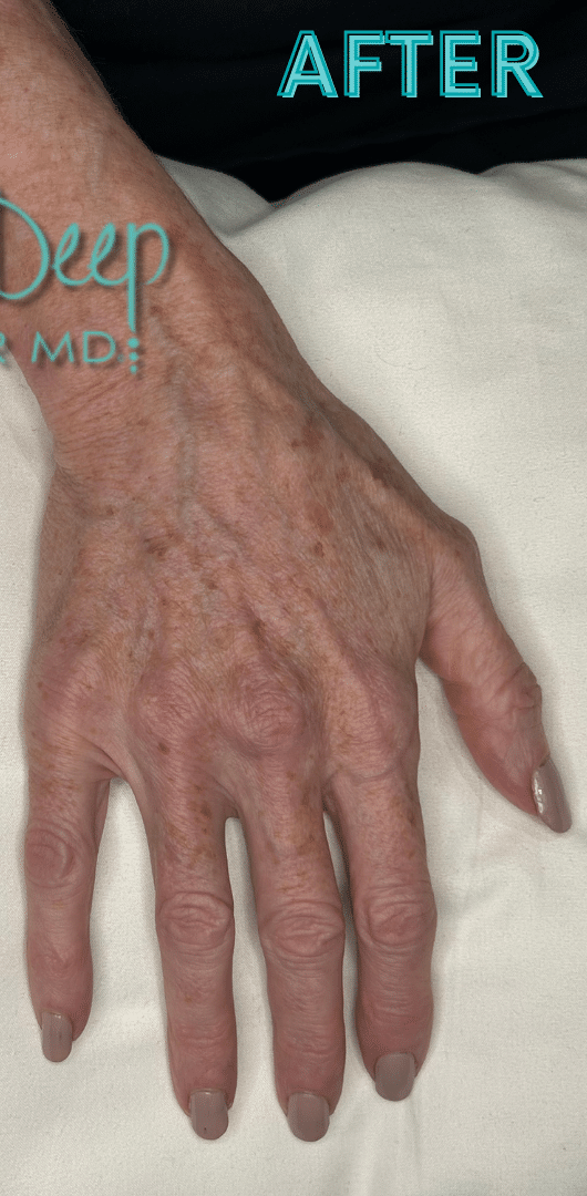 After Image: Fillers - front