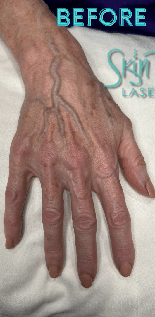 Before Image: Fillers - front