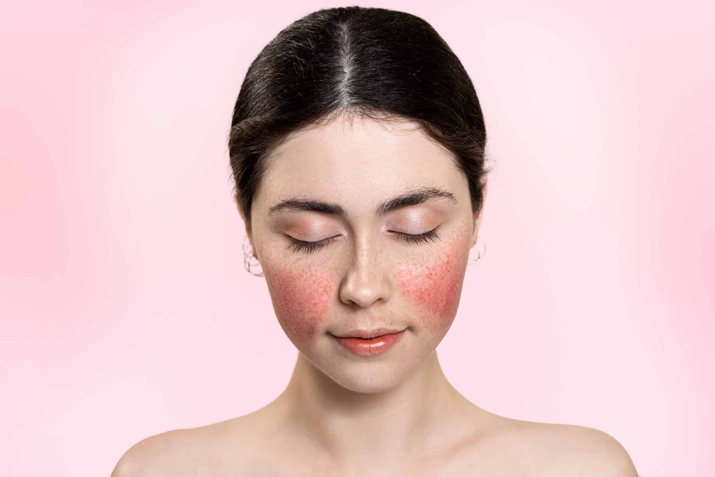 A woman with rosacea on her cheeks